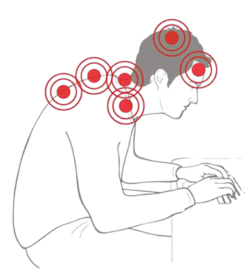 Illustration of a man hunched forward with his hands on a keyboard. Highlighted circles focus on points of strain on his head, neck, and upper back.